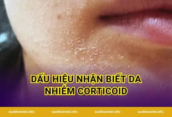 Dấu hiệu nhận biết da nhiễm corticoid