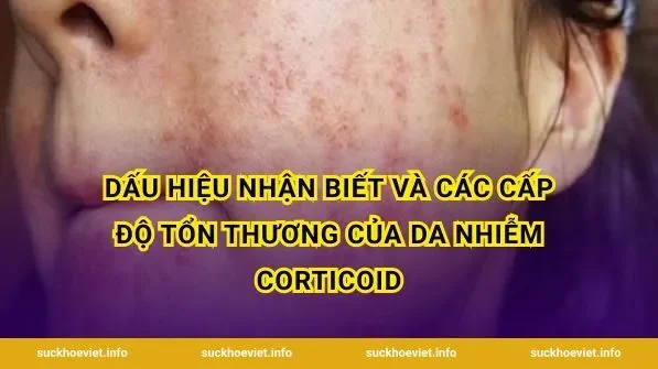 Dấu hiệu nhận biết và các cấp độ tổn thương của da nhiễm corticoid