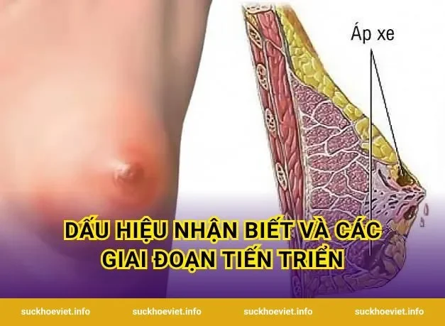 Dấu hiệu nhận biết và các giai đoạn tiến triển
