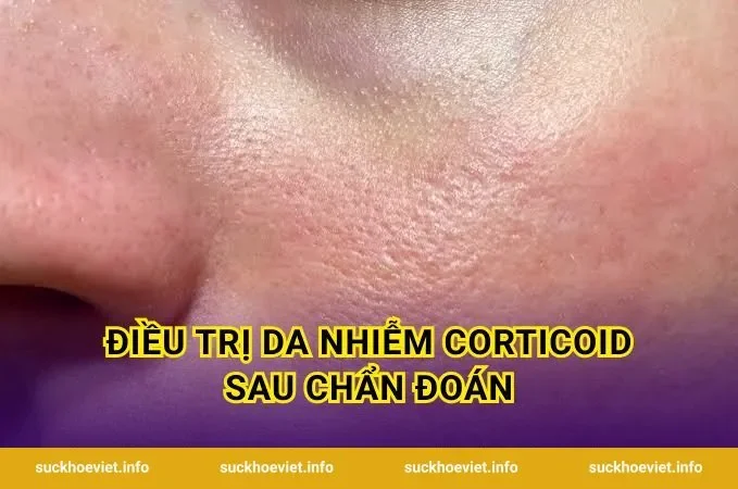 Điều Trị Da Nhiễm Corticoid Sau Chẩn Đoán