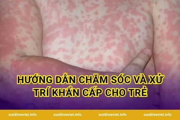 Hướng dẫn chăm sóc và xử trí khẩn cấp cho trẻ