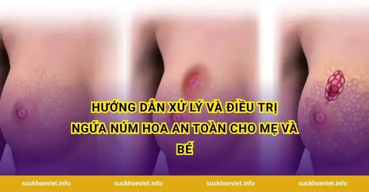 Hướng dẫn xử lý và điều trị ngứa núm hoa an toàn cho mẹ và bé