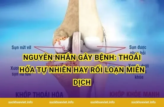 Nguyên Nhân Gây Bệnh: Thoái Hóa Tự Nhiên Hay Rối Loạn Miễn Dịch