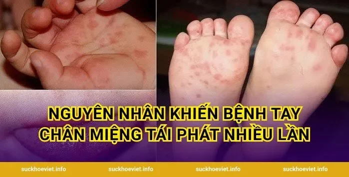 Nguyên nhân khiến bệnh tay chân miệng tái phát nhiều lần