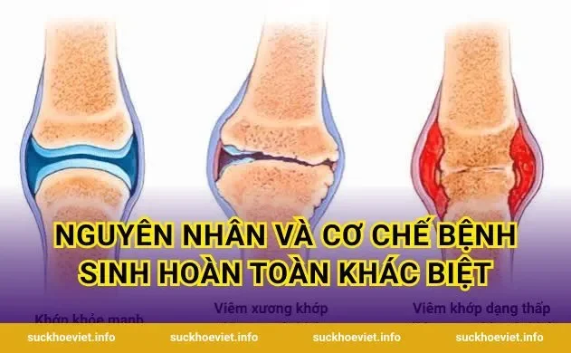 Nguyên nhân và cơ chế bệnh sinh hoàn toàn khác biệt
