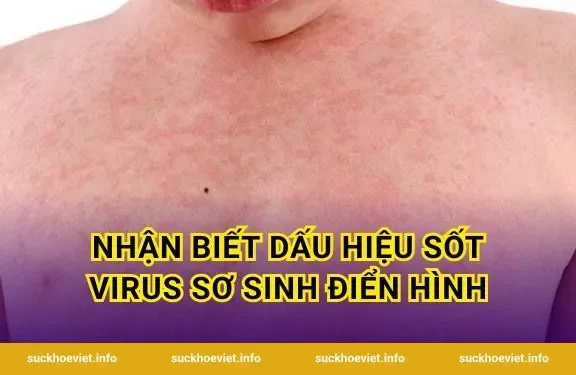 Nhận biết dấu hiệu sốt virus sơ sinh điển hình