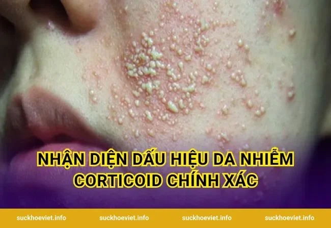 Nhận Diện Dấu Hiệu Da Nhiễm Corticoid Chính Xác