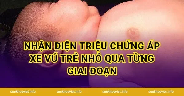 Nhận diện triệu chứng áp xe vú trẻ nhỏ qua từng giai đoạn