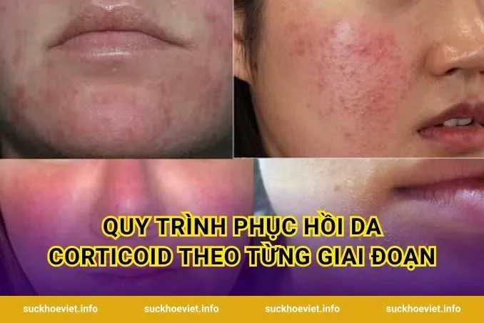 Quy Trình Phục Hồi Da Corticoid Theo Từng Giai Đoạn