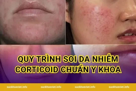 Quy Trình Soi Da Nhiễm Corticoid Chuẩn Y Khoa