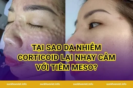 Tại sao da nhiễm corticoid lại nhạy cảm với tiêm meso?
