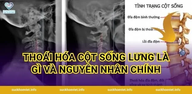 Thoái Hóa Cột Sống Lưng Là Gì Và Nguyên Nhân Chính