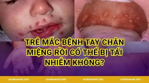 Trẻ mắc bệnh tay chân miệng rồi có thể bị tái nhiễm không?