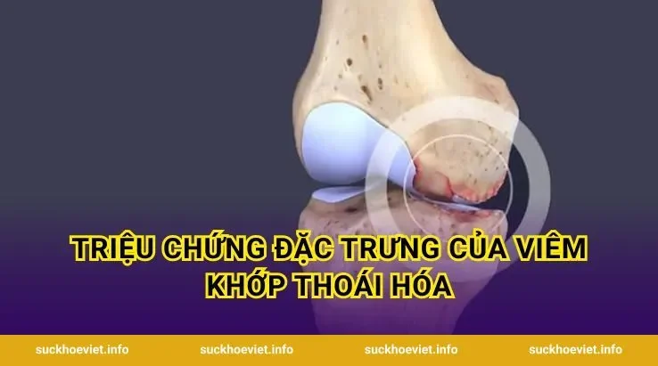 Triệu Chứng Đặc Trưng Của Viêm Khớp Thoái Hóa